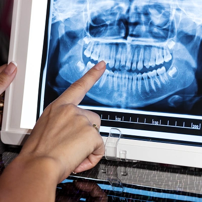 Dentist pointing at a digital X-ray showing a detailed panoramic view of teeth and jaw