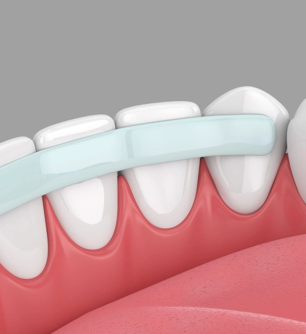 Illustration of composite resin dental bonding applied to restore the appearance of front teeth