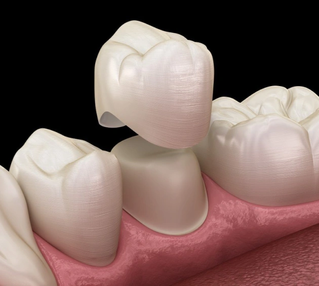 Illustration of a porcelain dental crown capping a damaged tooth for protection and restoration