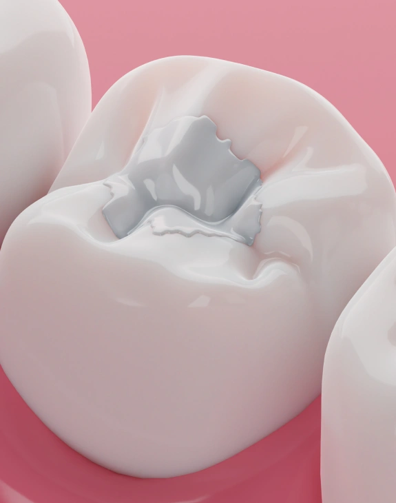 Dental Fillings