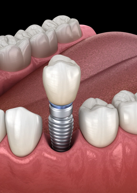 Dental Implants