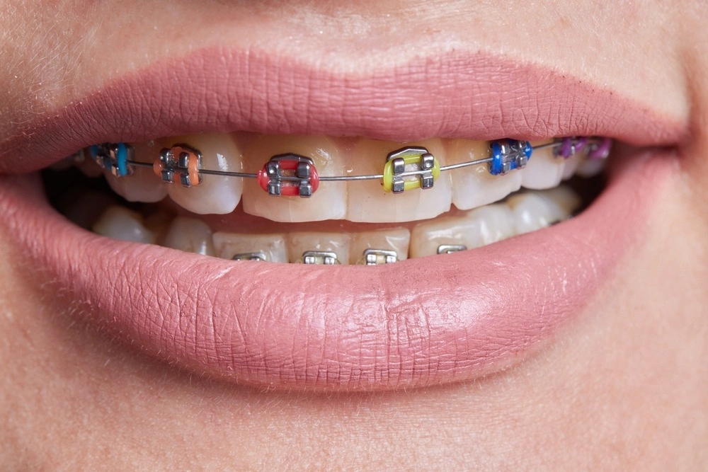 Broken Braces