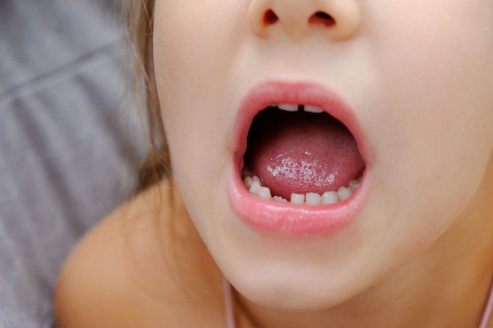 Chipped or Broken Teeth