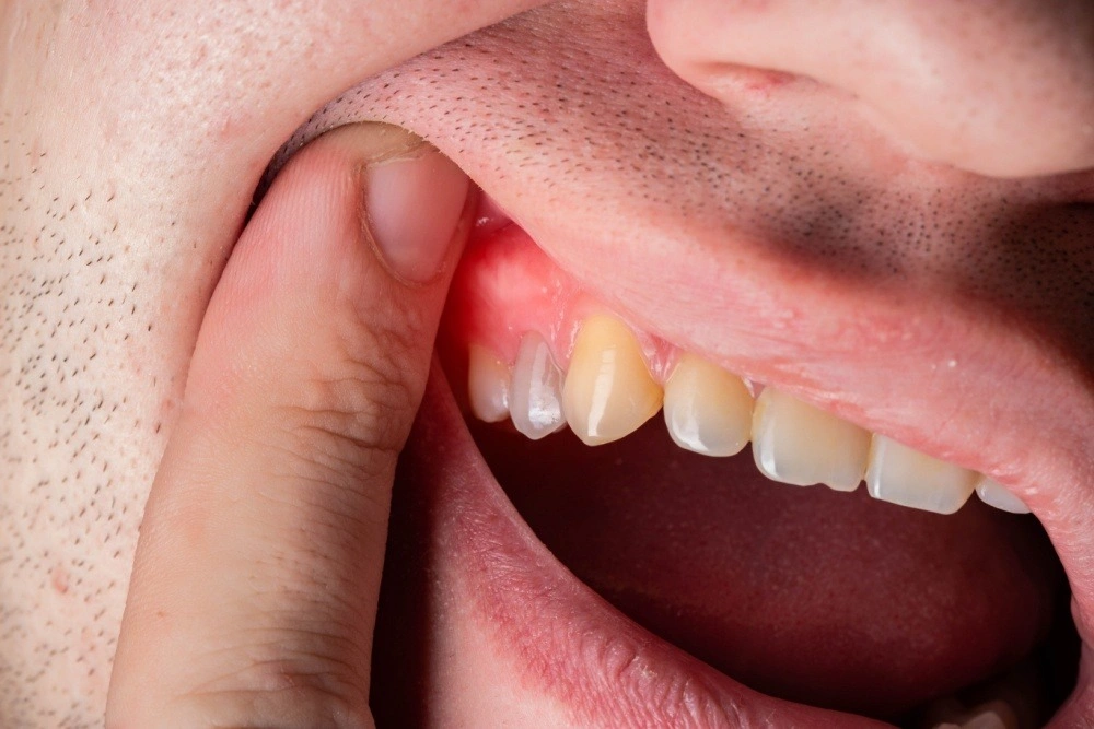 Abscess