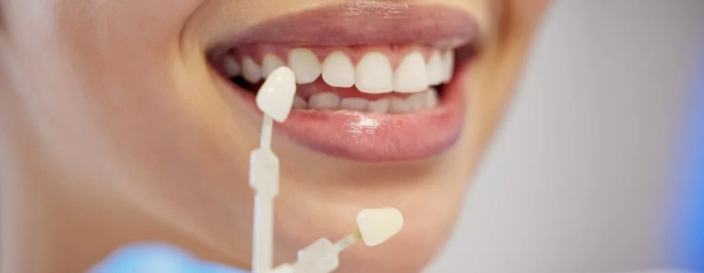 Veneer Bonding & Placement