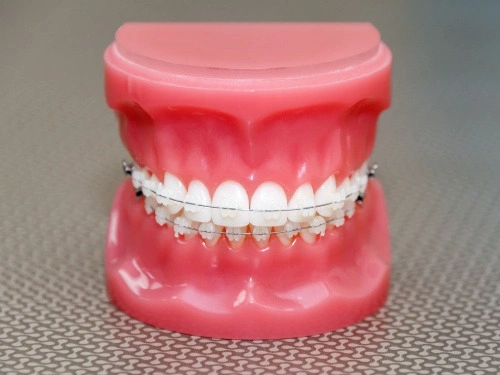 Ceramic Braces