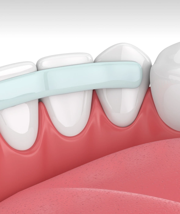 Dental bonding treatment improving the appearance of a patient's smile
