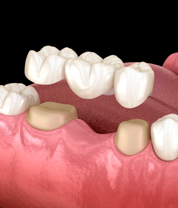 Dental bridge restoration replacing missing teeth