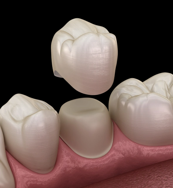 Dental crown restoration used to protect and strengthen a damaged tooth
