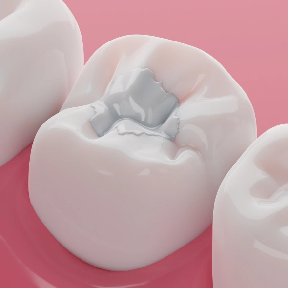 Tooth-colored filling used to restore a cavity and protect a tooth