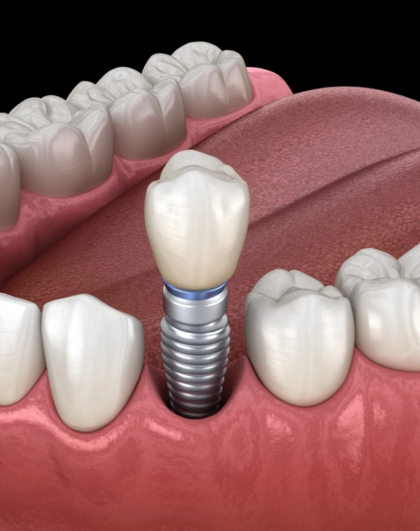 Dental implant restoration replacing a missing tooth