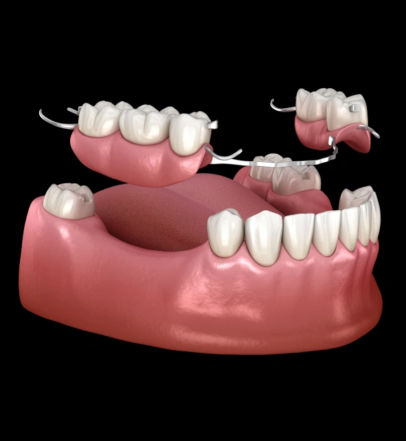 Denture restoration helping replace multiple missing teeth
