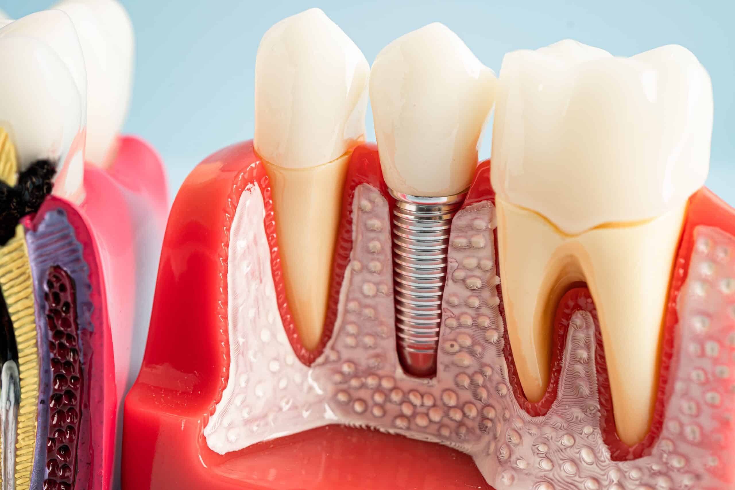 Dental Implants recovery