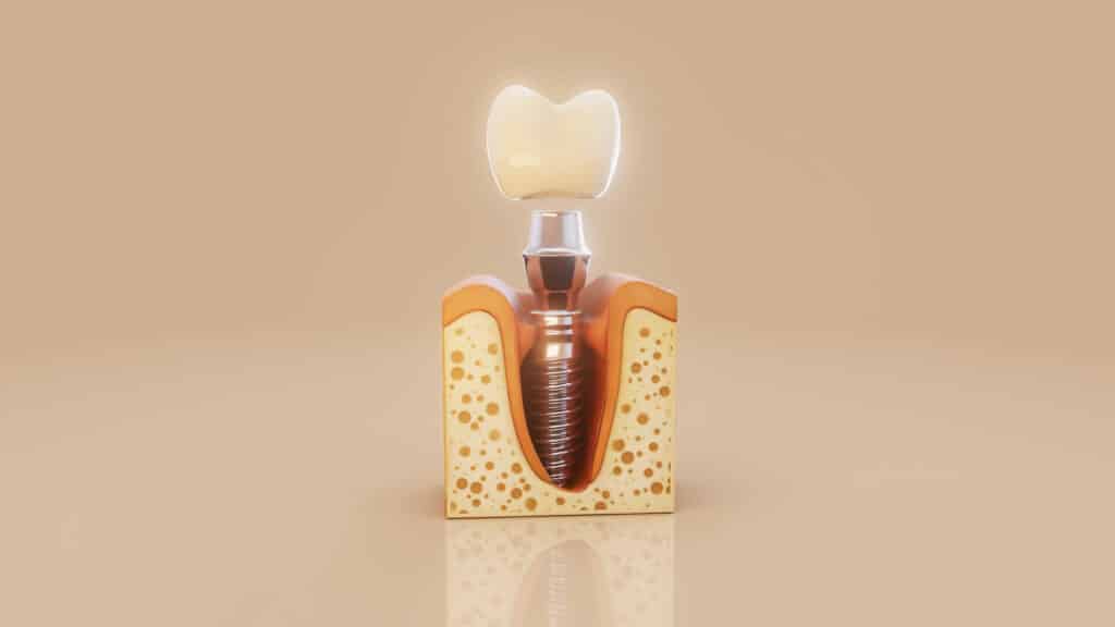 dental implant recovery stages