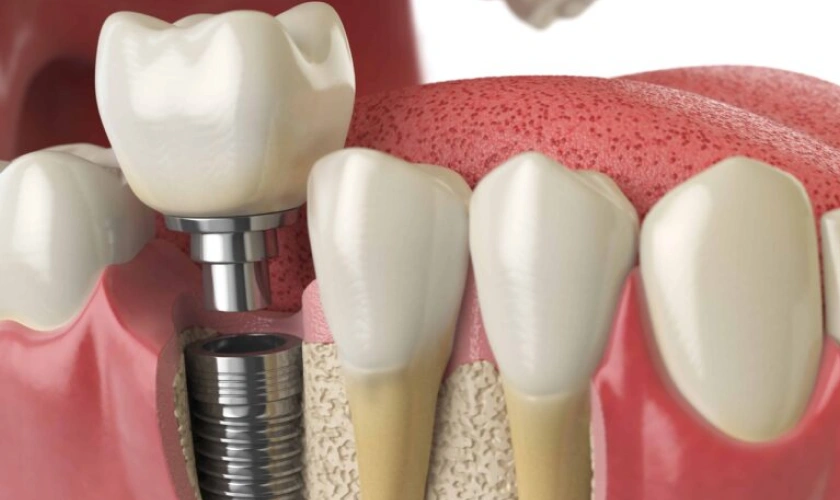 Dental implant graphics photo