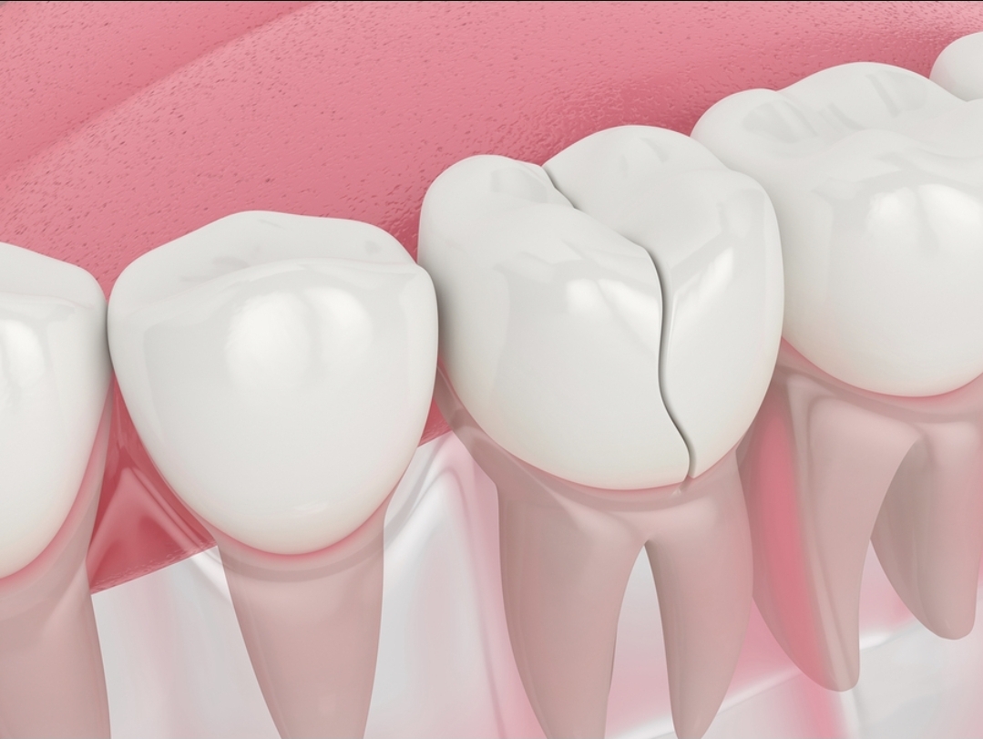 cracked teeth