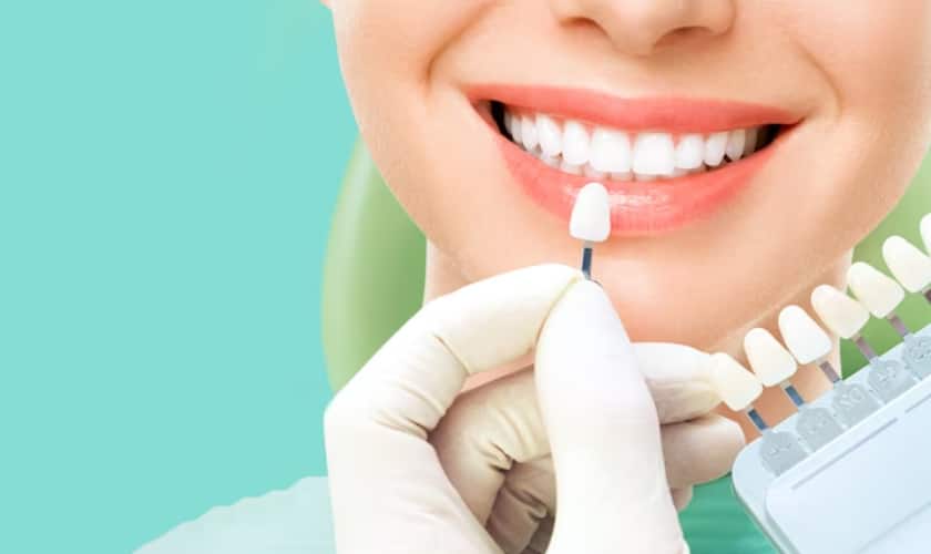 Benefits of Veneers