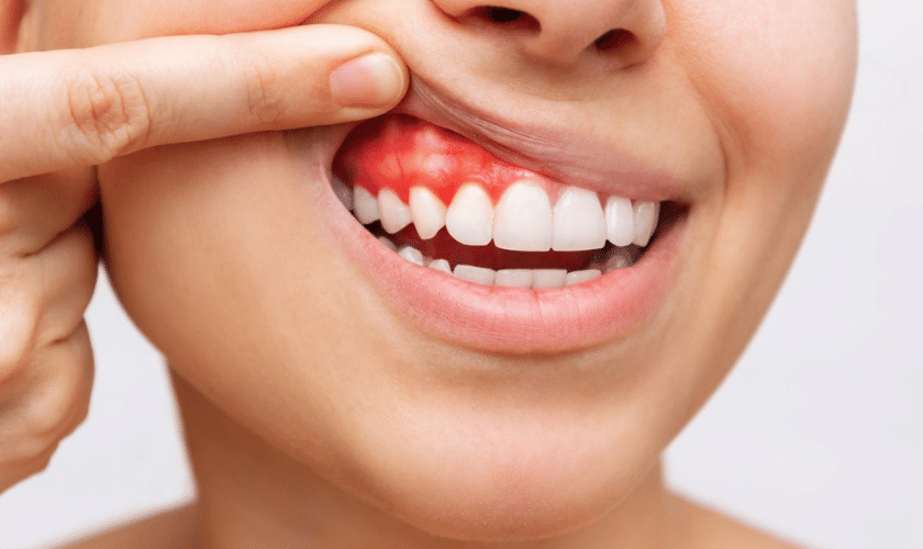 gum disease watford