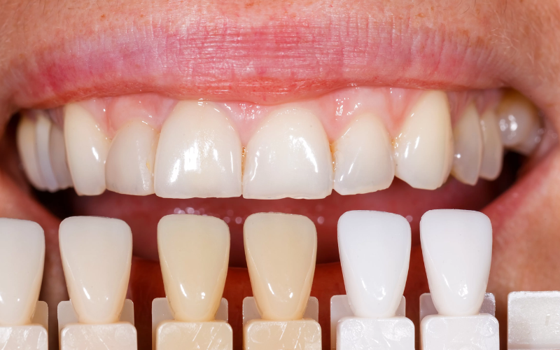 Do Porcelain Veneers Give Perfect Smile