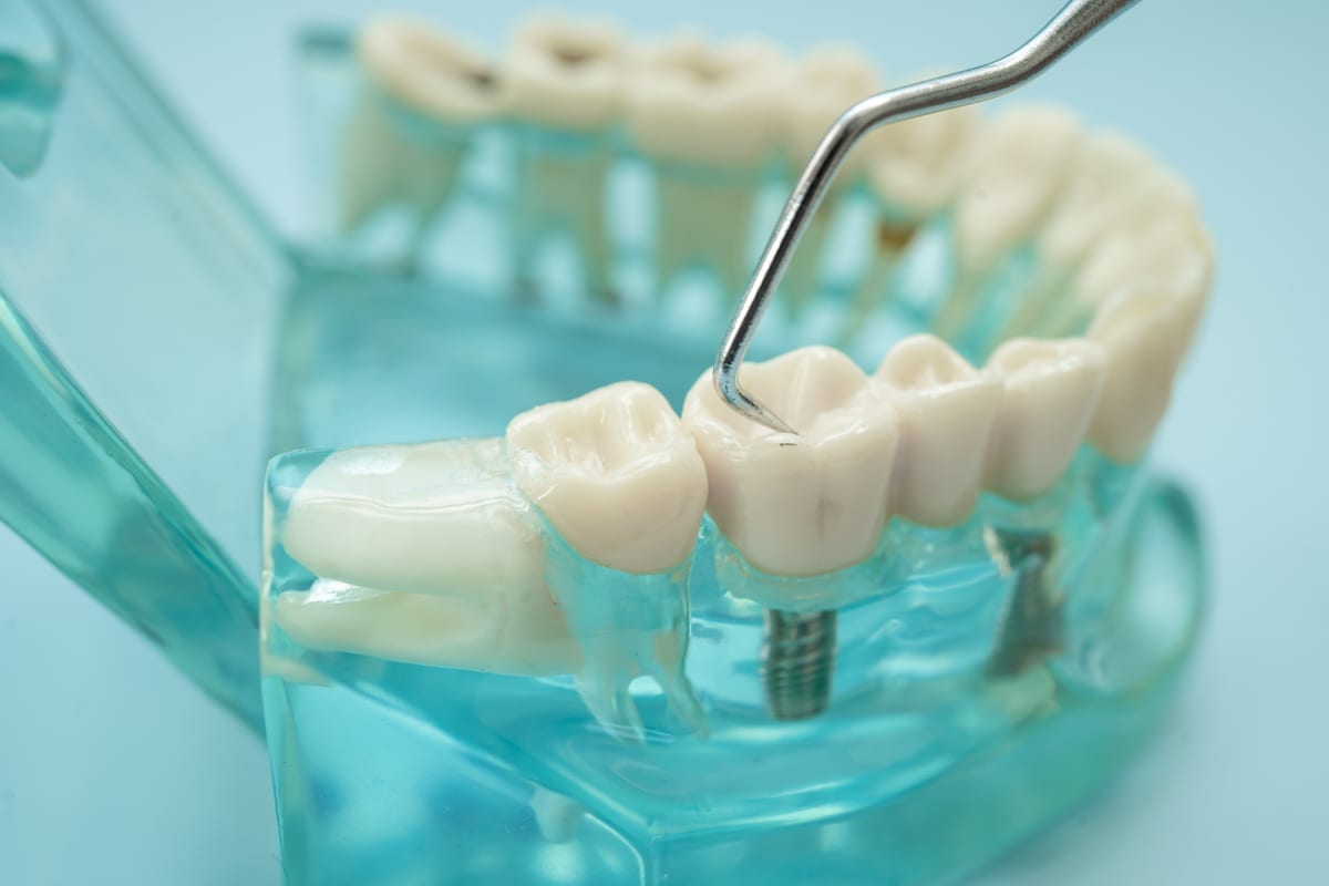 Dental Bridges in Albany