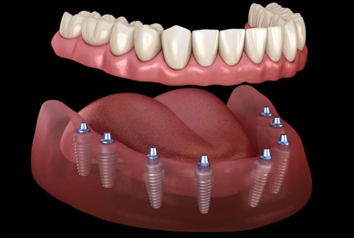 Full mouth Implant Dentures treatment at Westinghouse Dental Georgetown