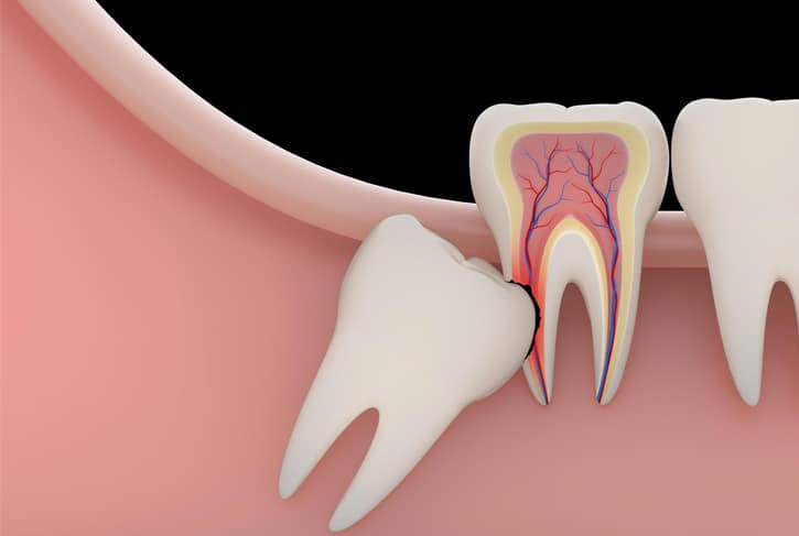 Wisdom teeth removal surgery at Westinghouse Dental in Georgetown, TX