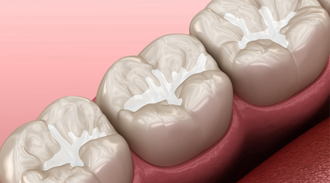 Dental Sealants treatment at Westinghouse Dental in Georgetown, TX