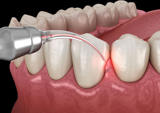 LASER for Gum Disease in Georgetown, TX