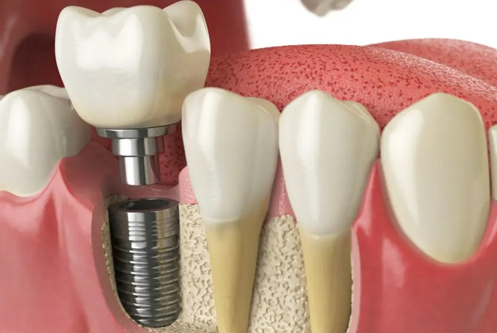 Westinghouse Dental Georgetown offers dental implants in Georgetown, TX
