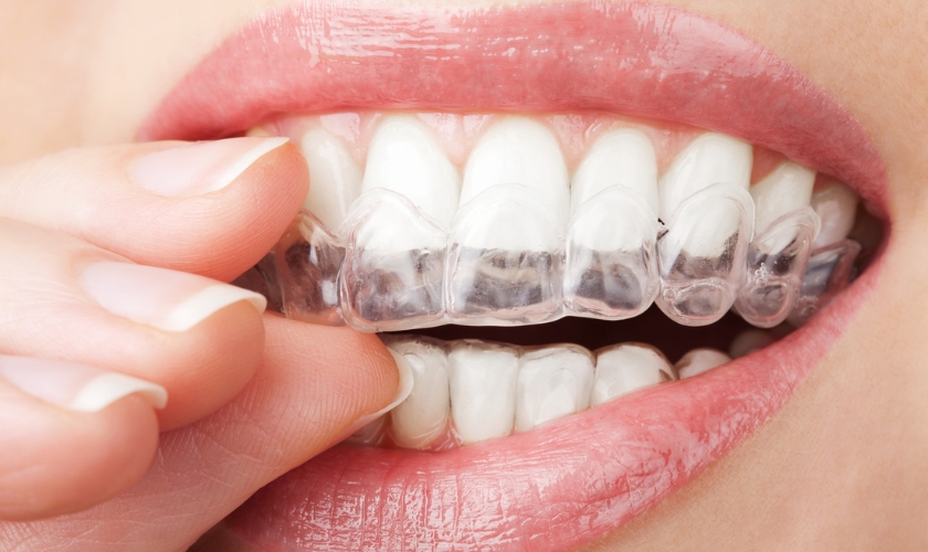 Clear Aligners Seattle