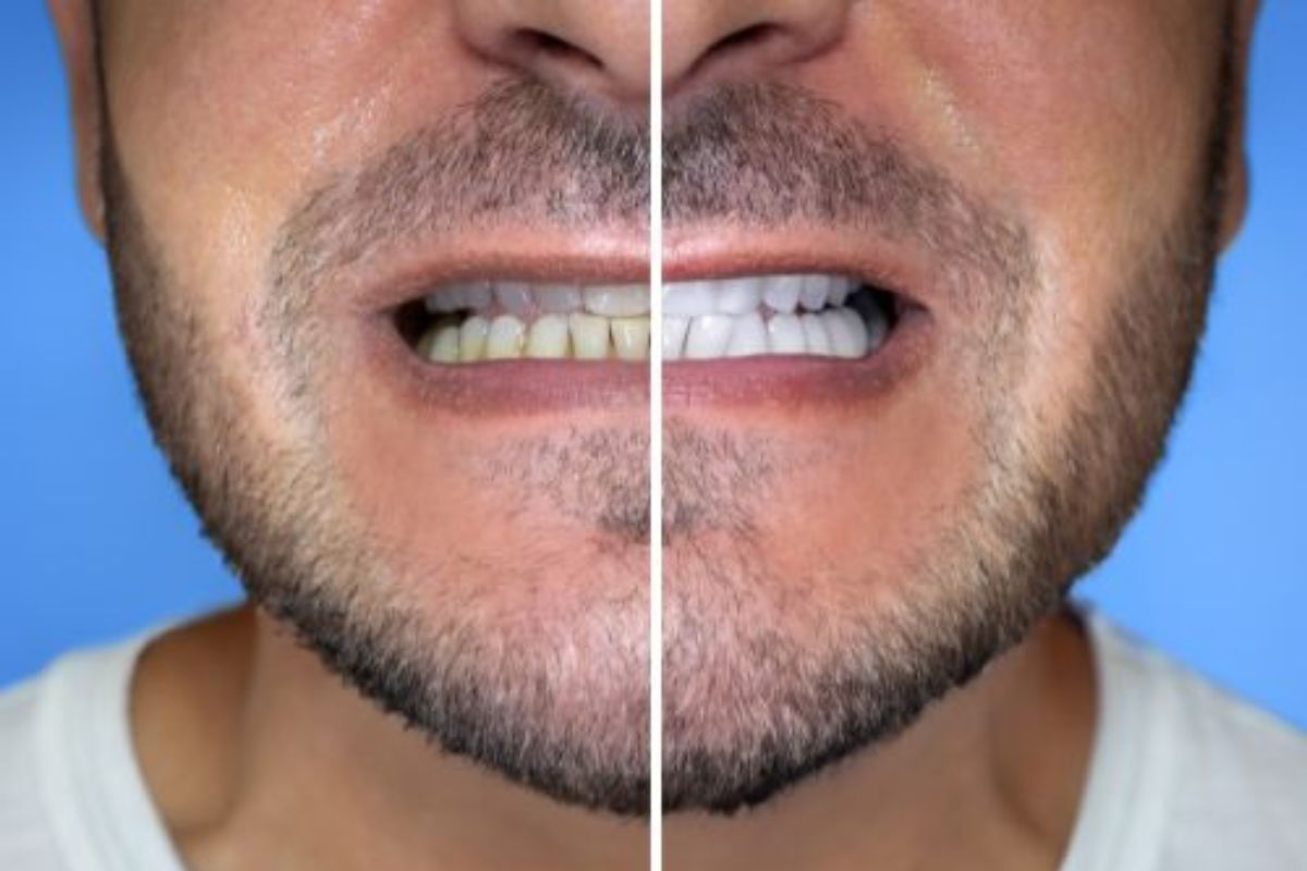 Teeth Whitening Seattle