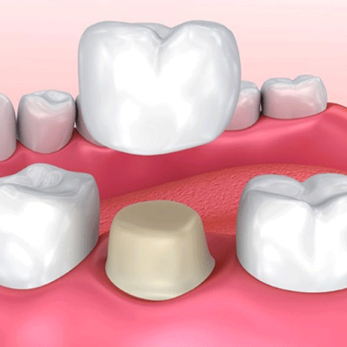 Loose Crowns