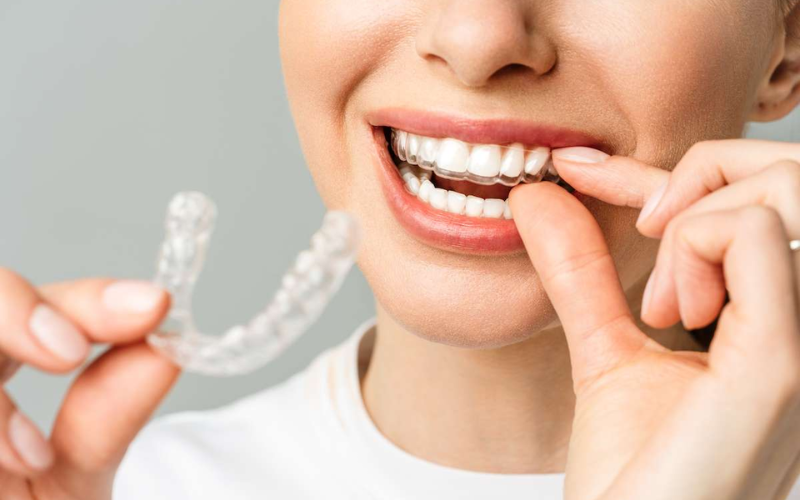 Invisalign for adults