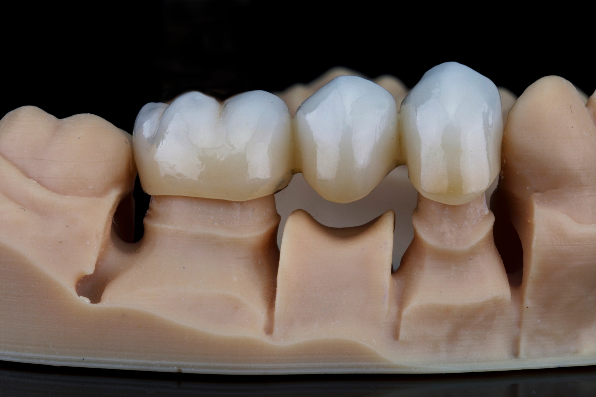 Dental Bridges In York, SC