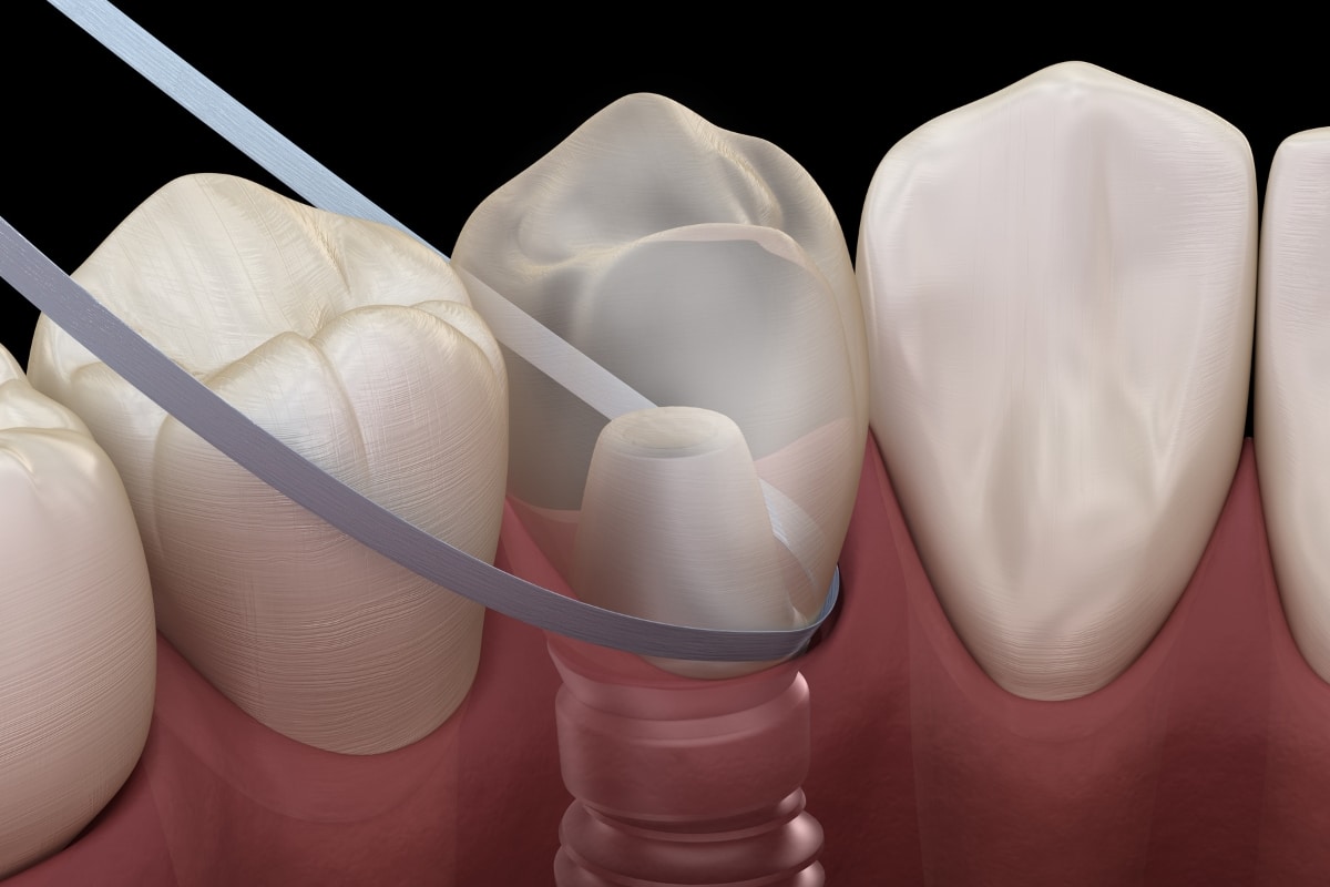 how can you floss with dental implants