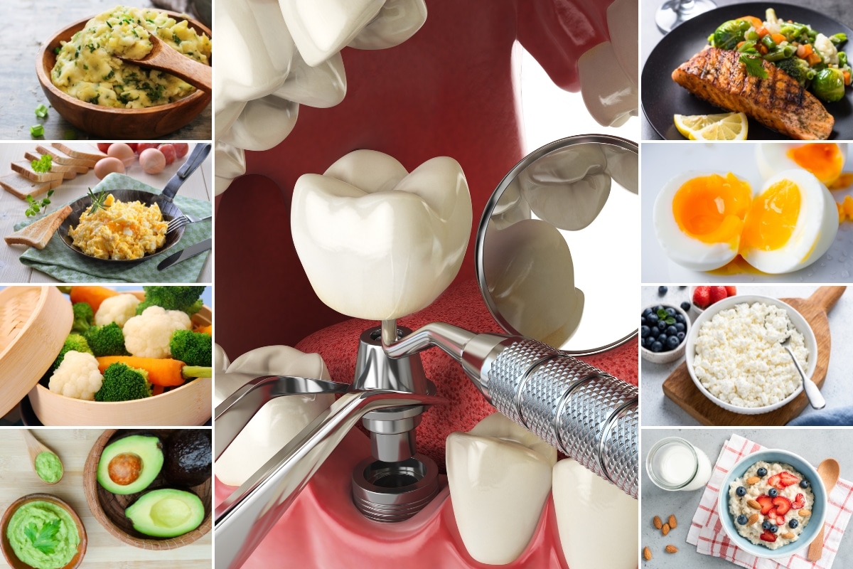 what can you eat after dental implant surgery