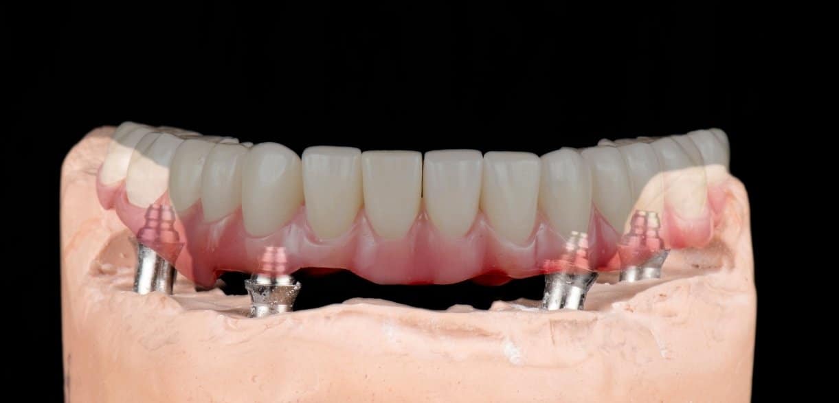 healing time and recovery tips after getting full mouth implants