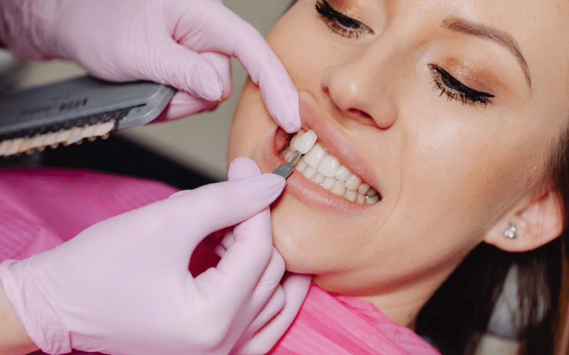 Benefits of Porcelain Veneers