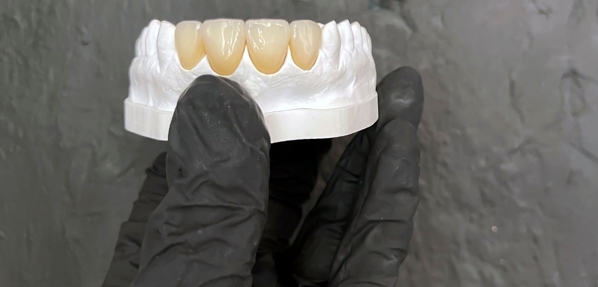 how crowns and bridges work together to protect your oral health