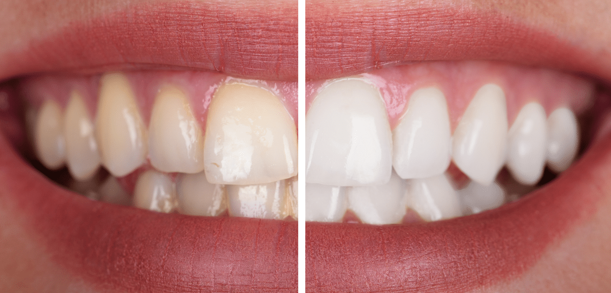 How Professional Teeth Cleaning Can Prevent Major Dental Concerns?