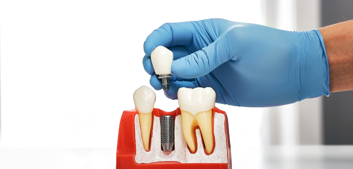 Dental Implants Last a Lifetime