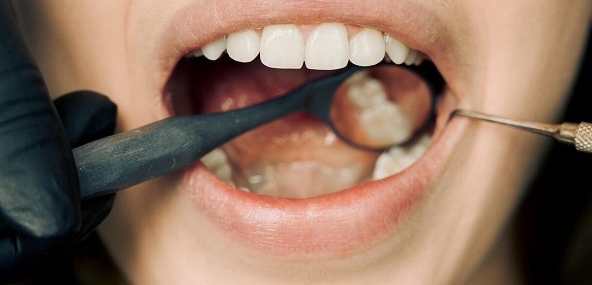 How can I manage pain and discomfort after wisdom teeth removal