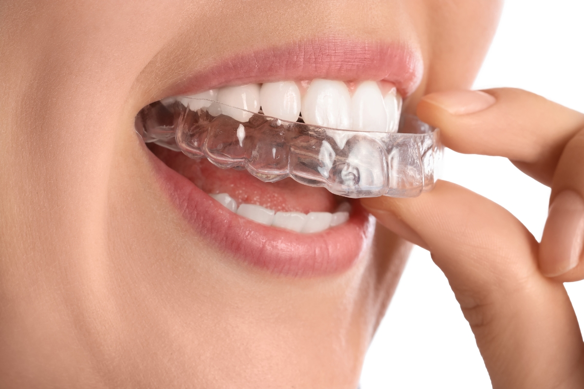 Occlusal Guards