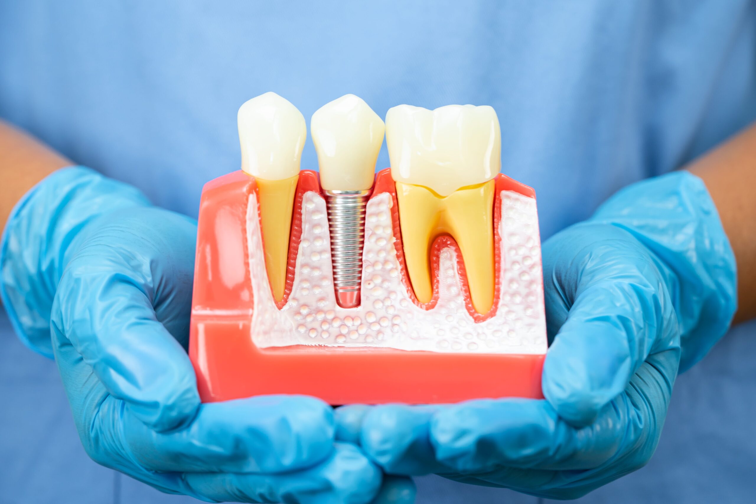 how dental implants work