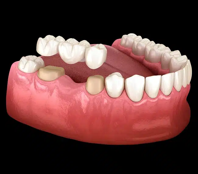Rebuild your smile with natural-looking dental bridges Willow Street Dental in Chippewa Falls, WI