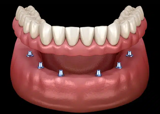 Dental Dentures, Partials & Mini Implants at Willow Street Dental in Chippewa Falls, WI