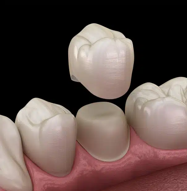 Restore your smile with dental crowns at Willow Street Dental in Chippewa Falls, WI