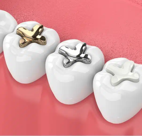 dental fillings to prevent cavities at Willow Street Dental in Chippewa Falls, WI