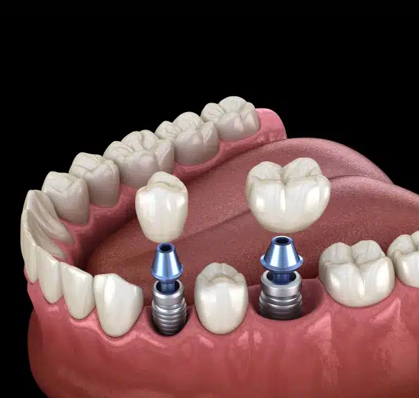 Dental implants treatment for patients in Chippewa Falls, WI at Willow Street Dental