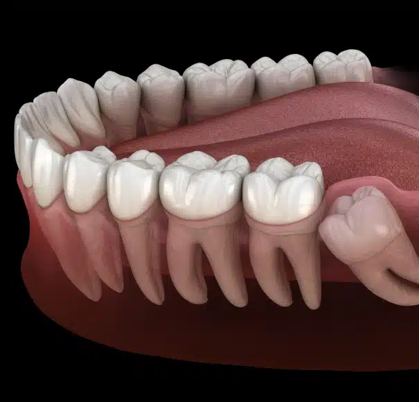 Wisdom teeth removal at Willow Street Dental in Chippewa Falls, WI
